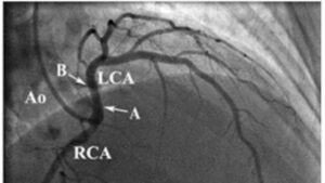 coronary anomalous