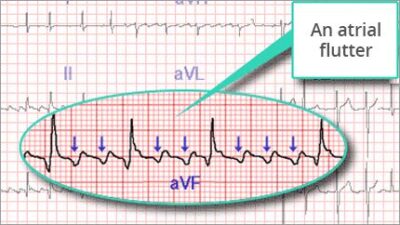 Atrial Flutter Top 10 – CardioVillage