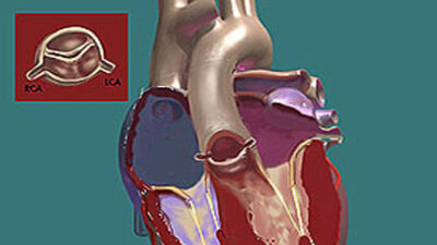 Bicuspid Aortic Valve and Pulmonic Stenosis – CardioVillage